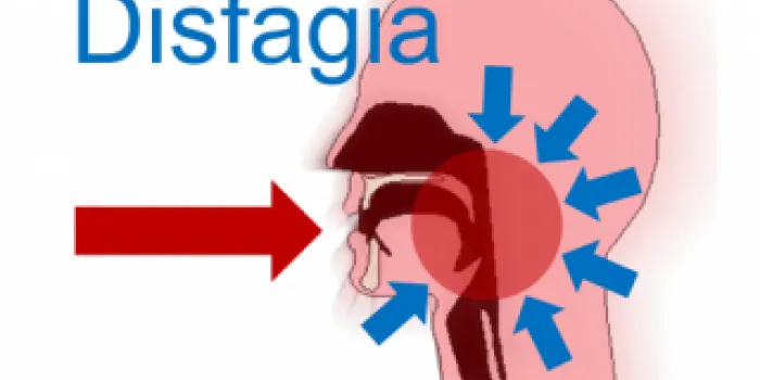 Les persones que han patit un ictus es recuperen abans i millor gràcies al tractament precoç de la disfàgia