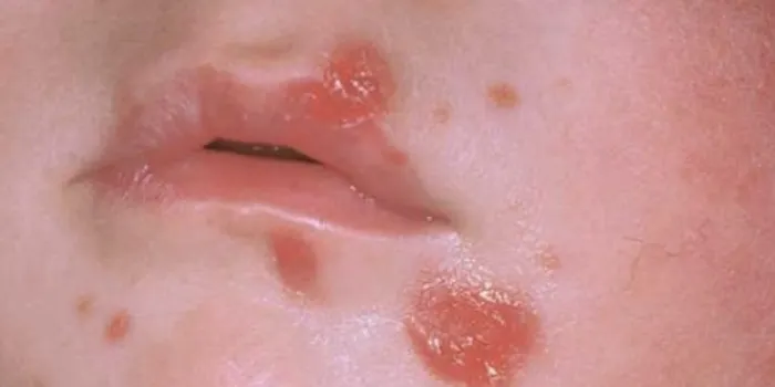 El CAP d’Arenys de Mar atén casos d’impetigen