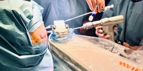 Primera cirurgia làser a l'estat per tractar amb ablació termal un glioblastoma inoperable