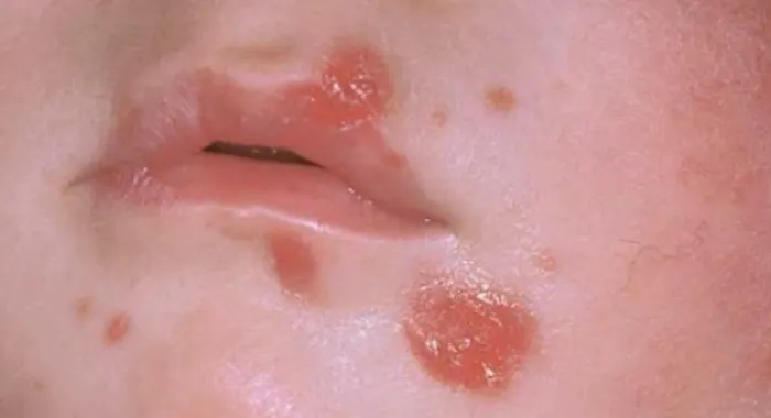 El CAP d’Arenys de Mar atén casos d’impetigen