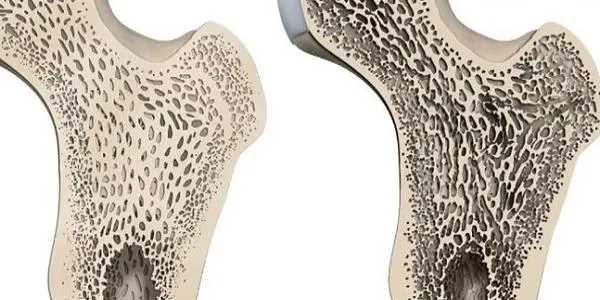 La URV valida un prototip per a la detecció de l'osteoporosi en fase inicial