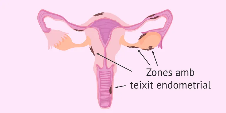 Avui dilluns 14 de març els llums de la façana de l’Ajuntament s’encendran de color groc pel Dia Mundial de l’Endometriosi